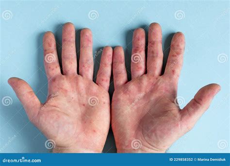 mani con rash cutaneo e bollicine