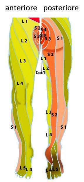 Mappa che illustra la distribuzione del dolore irradiato da un'ernia del disco lombare