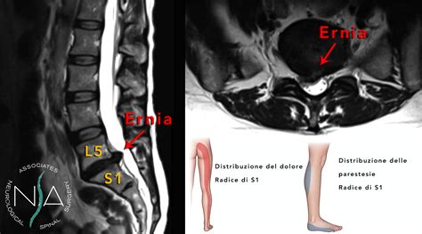 Esempio di Risonanza Magnetica che mostra un'ernia del disco lombare