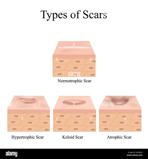 Schema comparativo tra cicatrice piana, ipertrofica, atrofica e cheloide