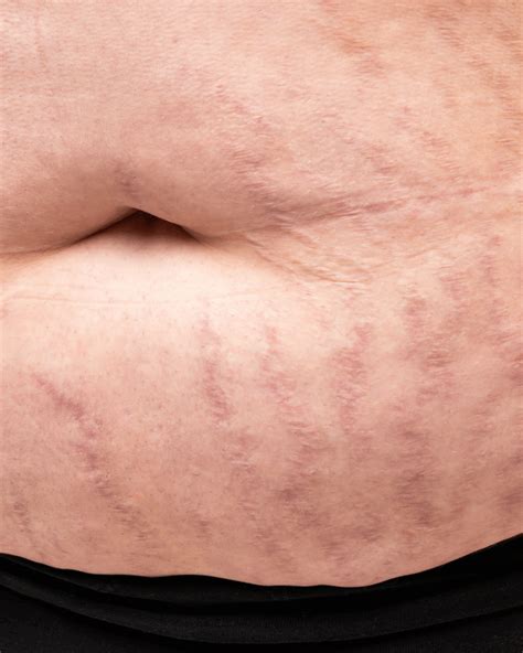 Immagine che mostra diverse fasi di smagliature e l'applicazione di un prodotto Lierac