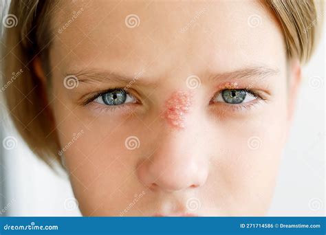 Bambino con eczema sul viso