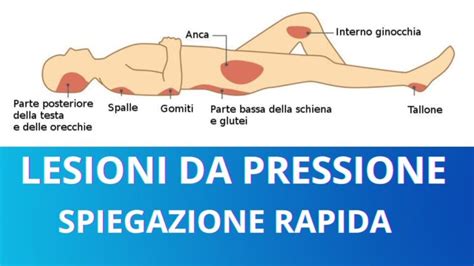 Mappa che illustra le aree corporee più frequentemente colpite da ulcere da pressione