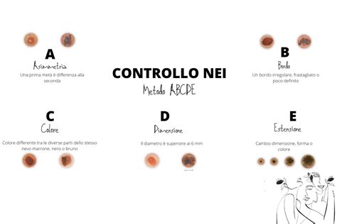 Schema del metodo ABCDE per il controllo dei nei