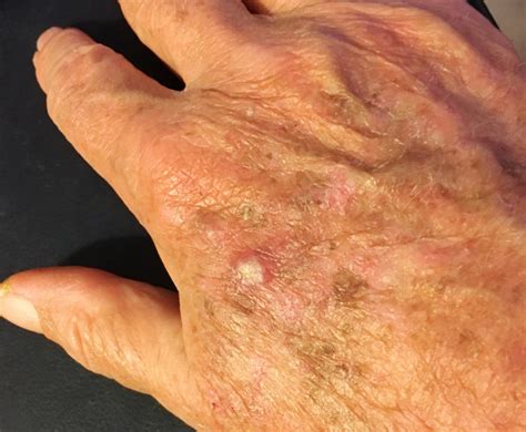Esempio di cheratosi attinica sul dorso della mano