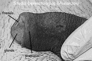 Pene umano con dettaglio della cicatrice da circoncisione