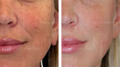 Immagine comparativa di pelle con melasma prima e dopo trattamento con acido tranexamico