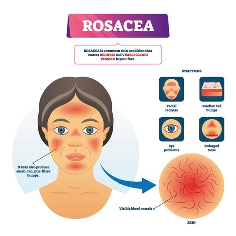 Schematic representation of facial skin with rosacea
