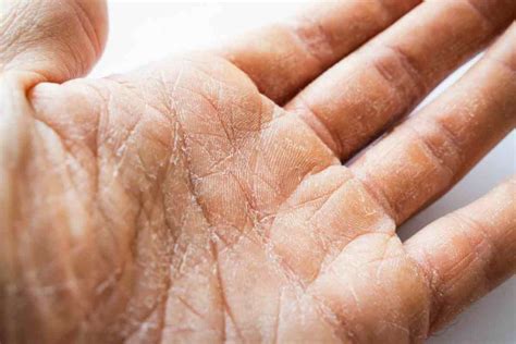 mani screpolate prima e dopo applicazione crema