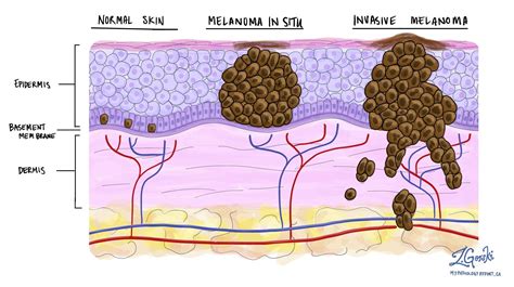 Cellule melanocitarie normali e melanoma