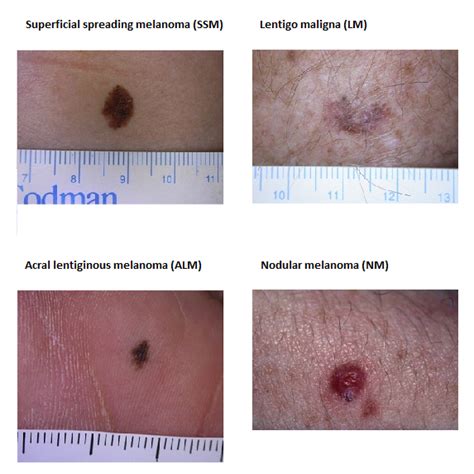 Melanoma a diffusione superficiale