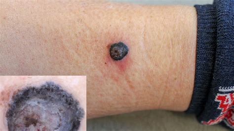 Melanoma nodulare