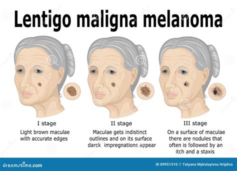 Lentigo maligna