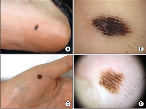 Melanoma acrale lentigginoso su palmo della mano