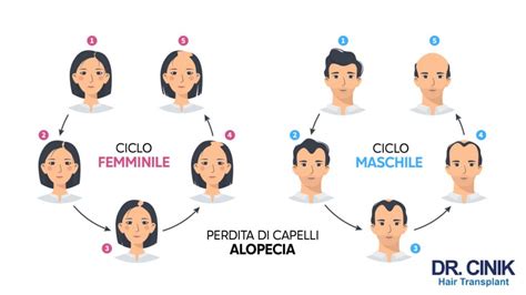 Schema dell'alopecia androgenetica femminile