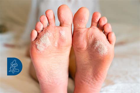 Piede con placche psoriasiche sulla pianta