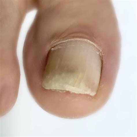 Unghia del piede affetta da psoriasi con onicolisi e pitting