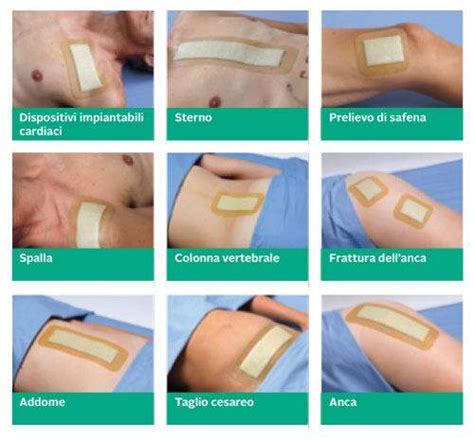 Medicazione di una ferita chirurgica