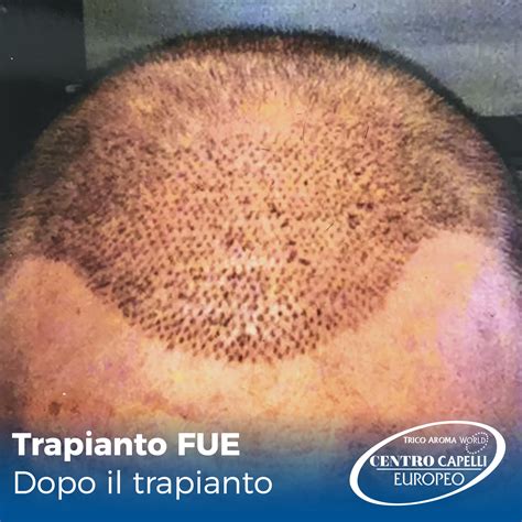 Clinica di trapianto di capelli