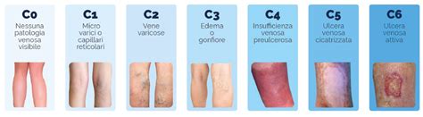 Diagramma che illustra le principali cause di ulcere cutanee: insufficienza venosa, arteriosa, diabete, pressione.