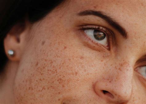 Donna con macchie sul viso