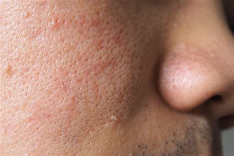 Pelle con pori ostruiti