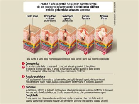 Diverse tipologie di lesioni acneiche