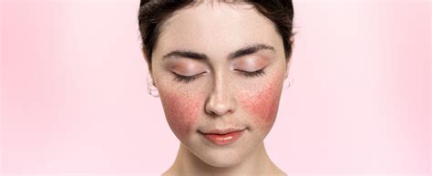 Pelle ipersensibile e reattiva