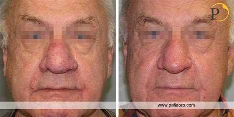 Immagine ravvicinata di un naso affetto da rinofima, mostrando ispessimento e dilatazione dei pori