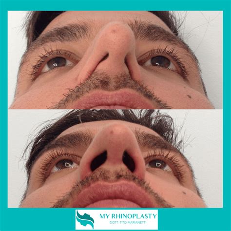 Schema che illustra le diverse parti del naso che possono essere modificate con la rinoplastica