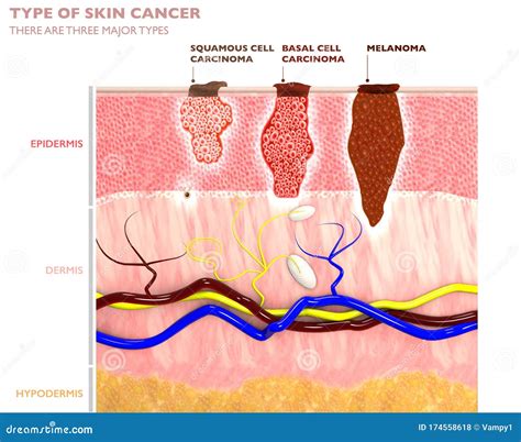 Illustrazione di batteri cutanei e pelle sana