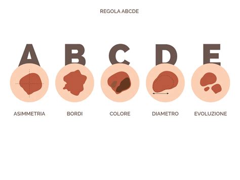Schema illustrativo della regola ABCDE per il riconoscimento del melanoma