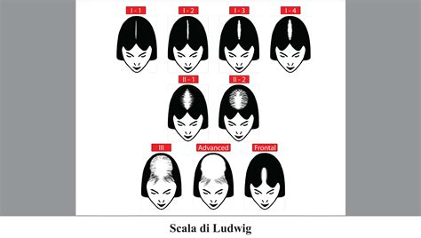 Schema delle fasi dell'alopecia androgenetica femminile secondo la scala di Ludwig