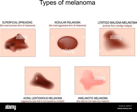 Immagini comparative delle diverse tipologie di melanoma (diffusione superficiale, nodulare, lentigo maligna, acro-lentigginoso)