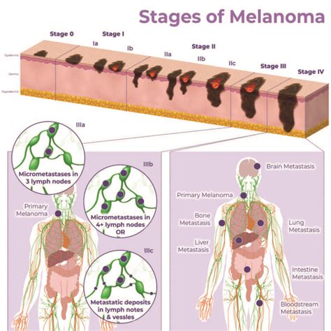 Diagramma che illustra gli stadi del melanoma e la potenziale diffusione ai linfonodi
