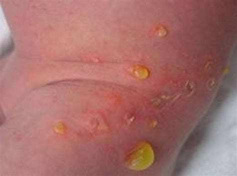 Impetigine non bollosa con croste giallo-miele sul viso di un bambino