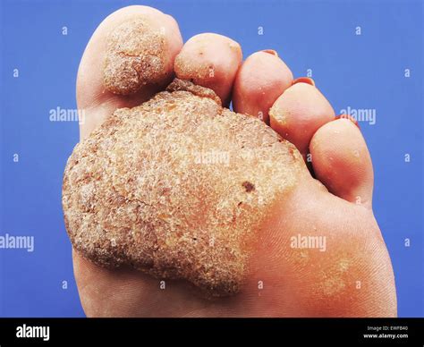 verruca plantare con punti neri