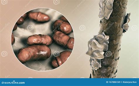 Illustrazione microscopica del fungo Malassezia globosa, un comune colpevole della forfora