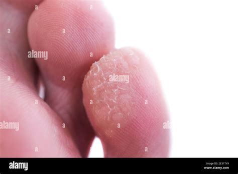 Immagine ravvicinata di una verruca comune su un dito