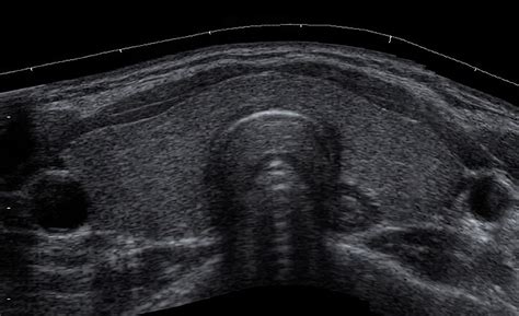 Ecografia tiroidea con ago aspirato in corso
