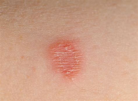 Chiazze a forma di anello sul braccio, tipiche della tinea corporis