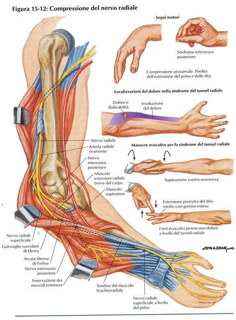 Illustrazione di un polso cadente (wrist drop) dovuto a lesione del nervo radiale
