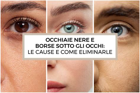 Diagramma che illustra la differenza tra borse sotto gli occhi (gonfiore) e occhiaie (colorazione scura)