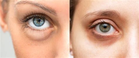 Infografica che elenca le cause principali di borse e occhiaie: sonno, stress, genetica, invecchiamento, alimentazione