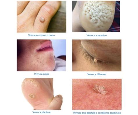 Diversi tipi di verruche
