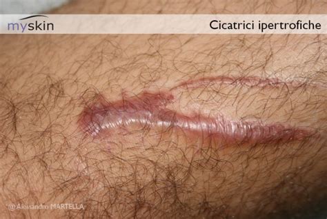 Mappa delle aree del corpo più soggette a cicatrici ipertrofiche