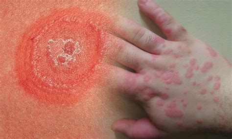 Lesioni a bersaglio dell'eritema polimorfo