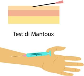 Persona che esegue un test di Mantoux su un braccio