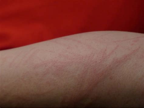 Arrossamento della pelle con dilatazione dei vasi sanguigni