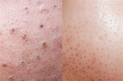 Naso umano con punti neri